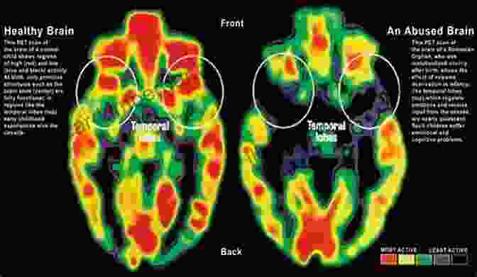 Anxiety Brain Scan Showing Hyperactivity In The Amygdala Why Am I So Anxious?: Powerful Tools For Recognizing Anxiety And Restoring Your Peace