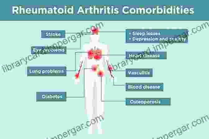 Causes Of Rheumatoid Arthritis Rheumatoid Arthritis Alfredo Morabia